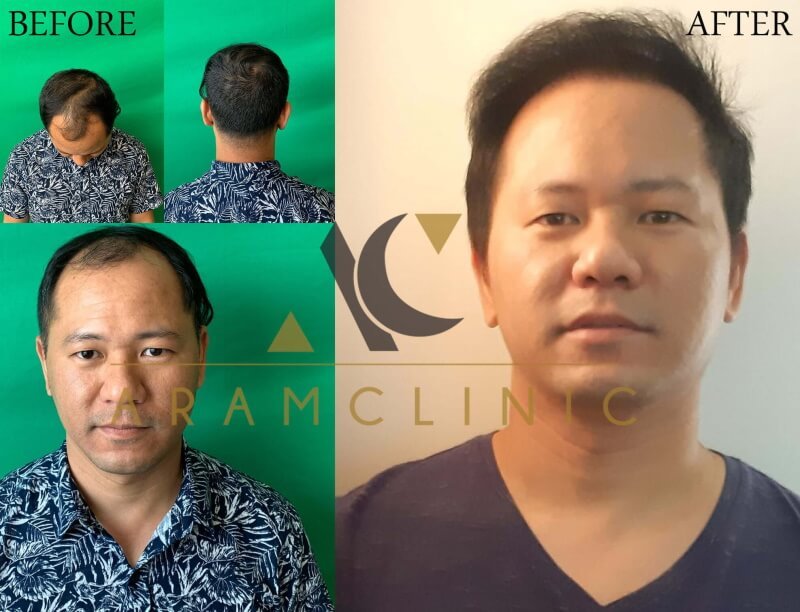 Haartransplantation