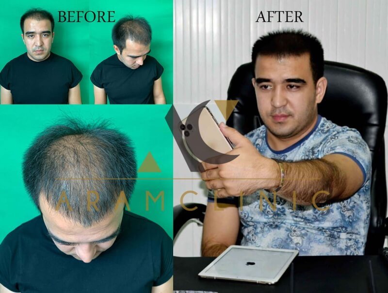 Haartransplantation