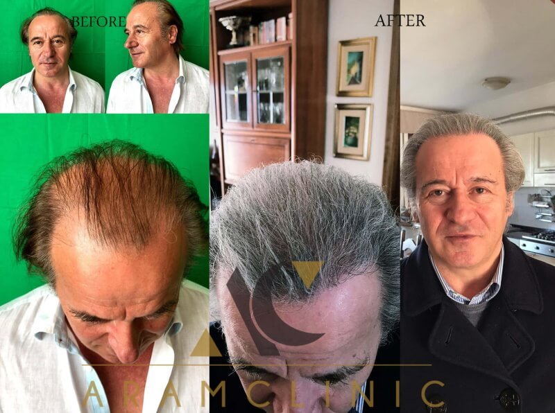 Haartransplantation