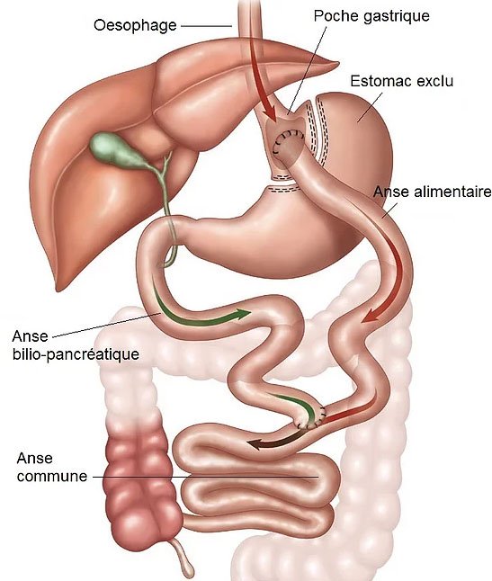  Magenbypass in der Türkei