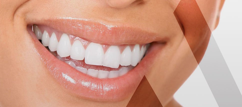 Veneers Türkei Kosten