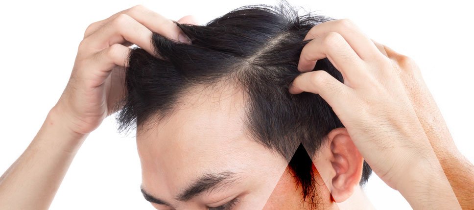 Haartransplantation Türkei Preise