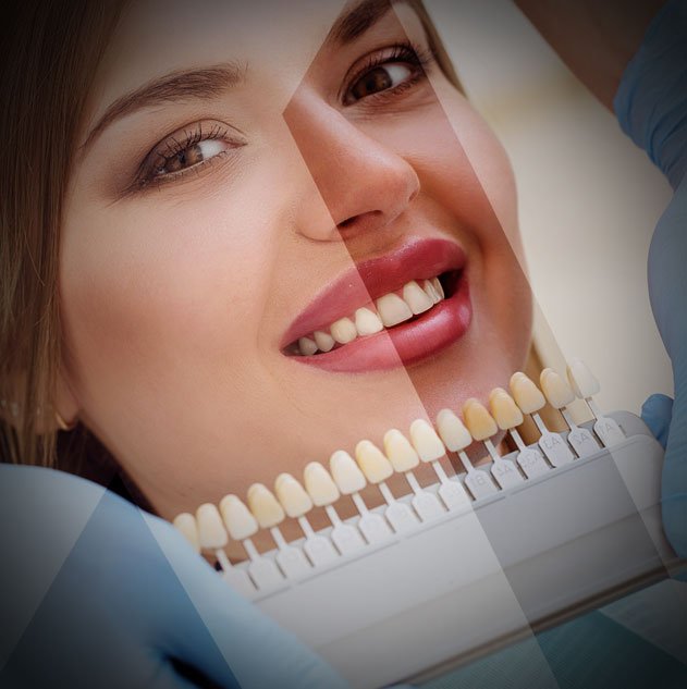 Zahn Veneers Türkei