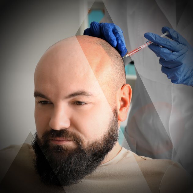 Haartransplantation Türkei Kosten